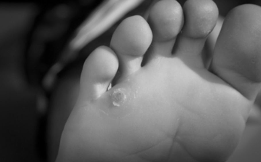 Deez Silicone Pinky Toe Protection