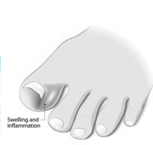 Deez Toe Silicone Cap